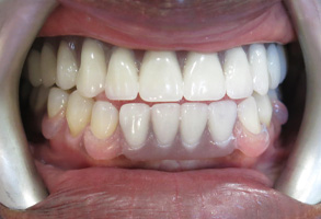 Lodi Family Dentistry | Snoring Appliances, Invisalign reg and Teeth Whitening