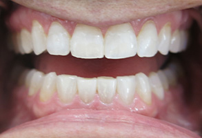 Lodi Family Dentistry | Extractions, TMJ Disorders and Oral Cancer Screening