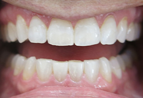 Lodi Family Dentistry | Periodontal Treatment, Snoring Appliances and 4-Implant Smile